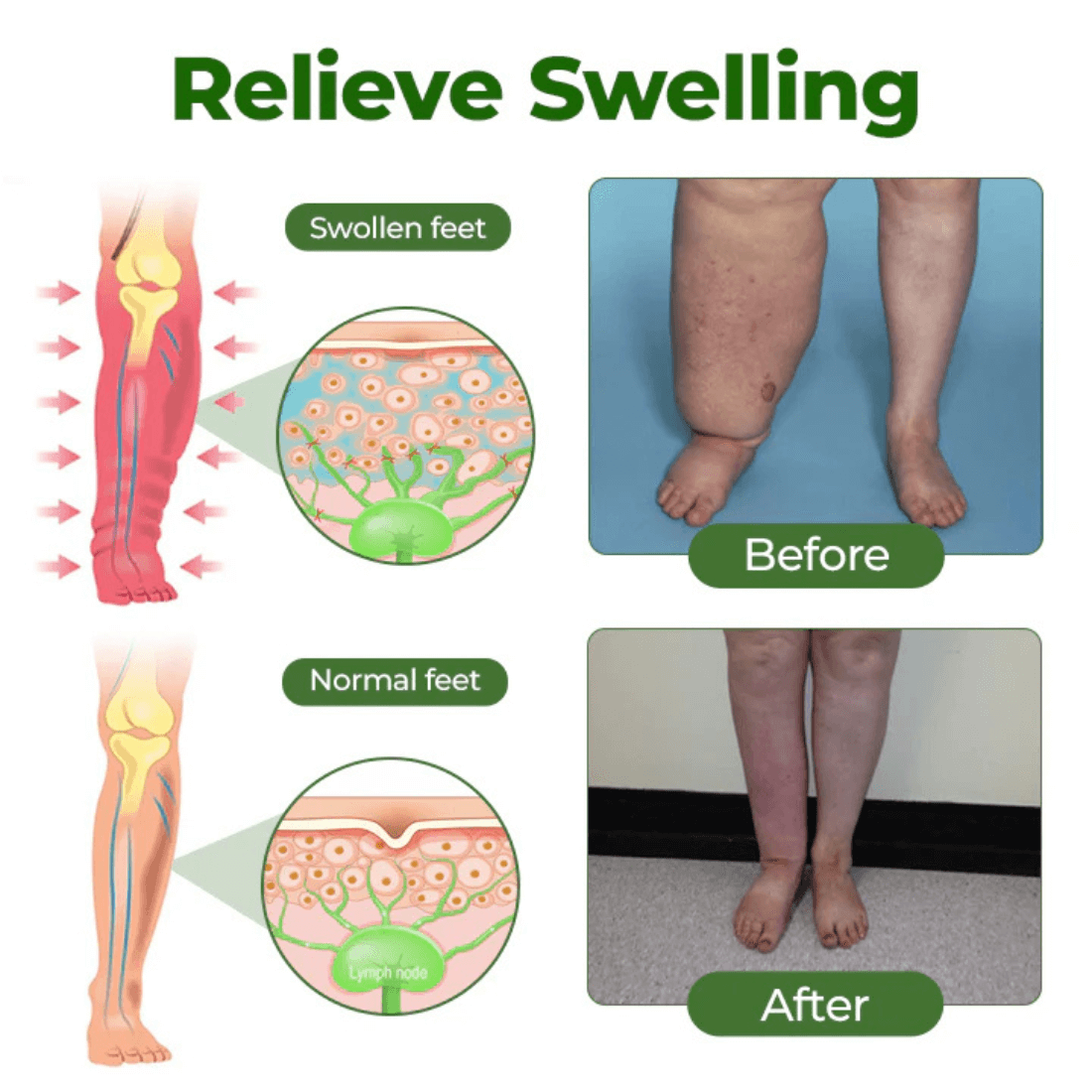 Alcuras™ Edema Relief Lotion
