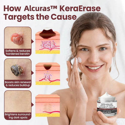 🔥Alcuras™ KeraErase Dual-Action Renewal Cream